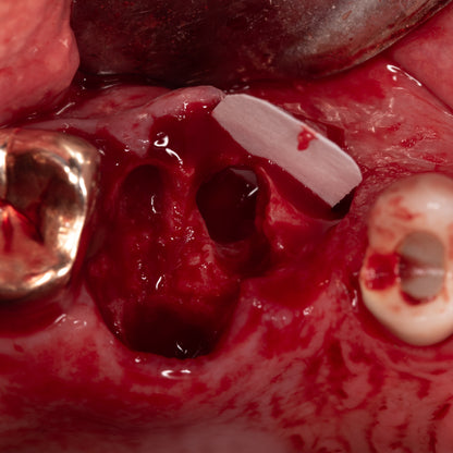 Surgery Live Streaming: Implant Placement June 14, 2024: Recording