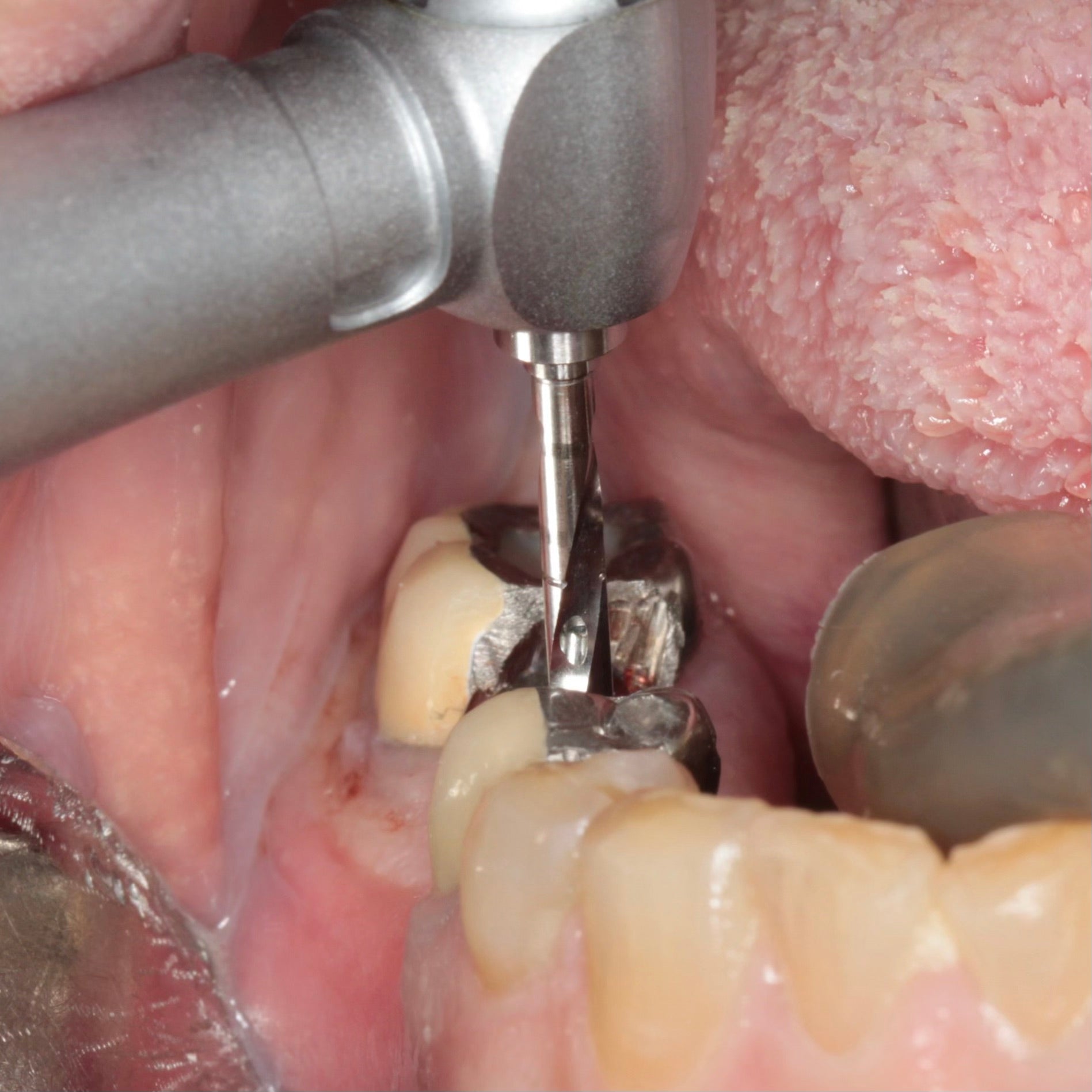 Dental Impant Surgery