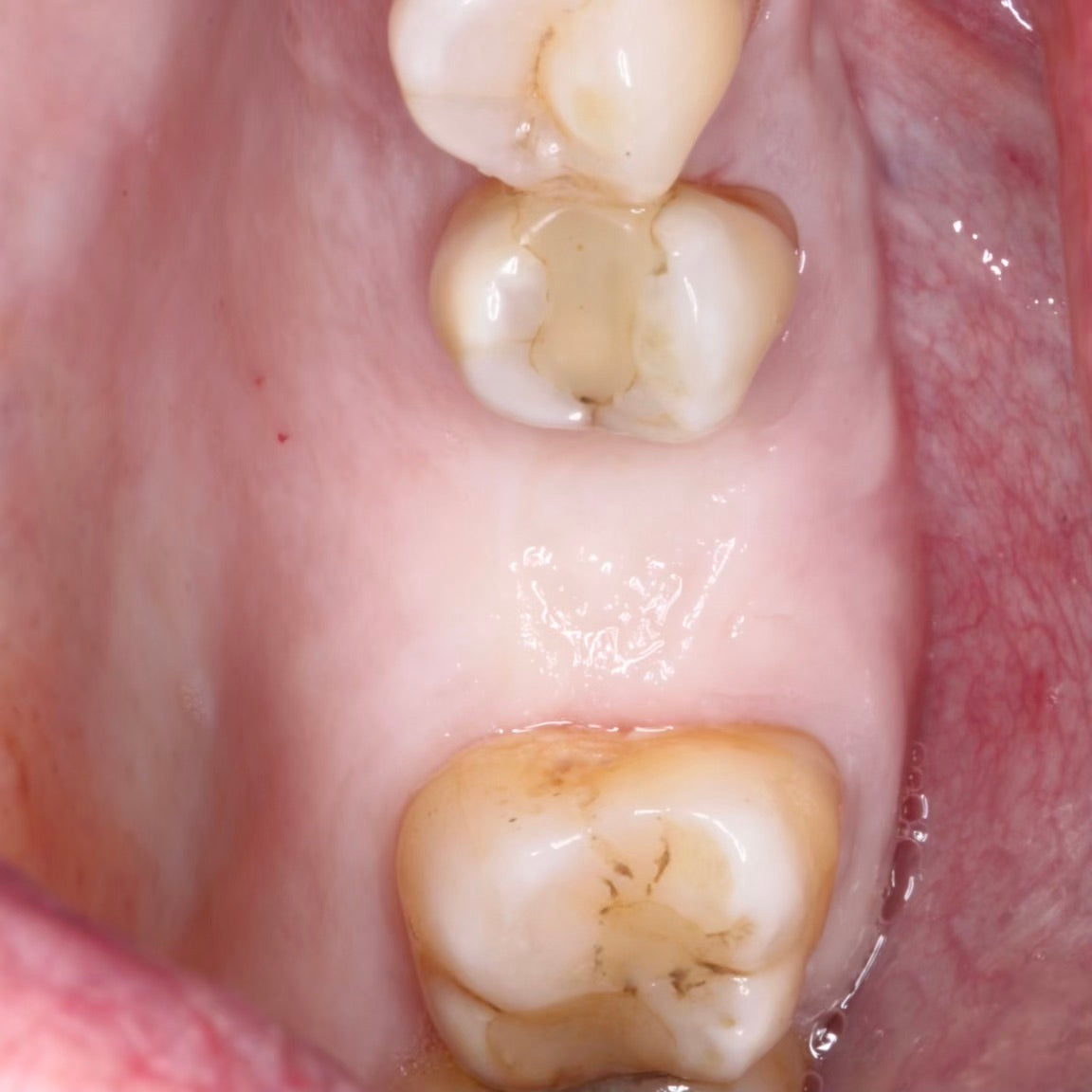 Surgery Live Streaming: Implant Placement June 14, 2024: Recording