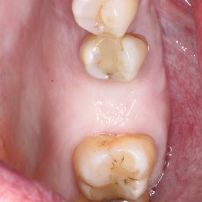 Surgery Live Streaming: Implant Placement June 14, 2024: Recording