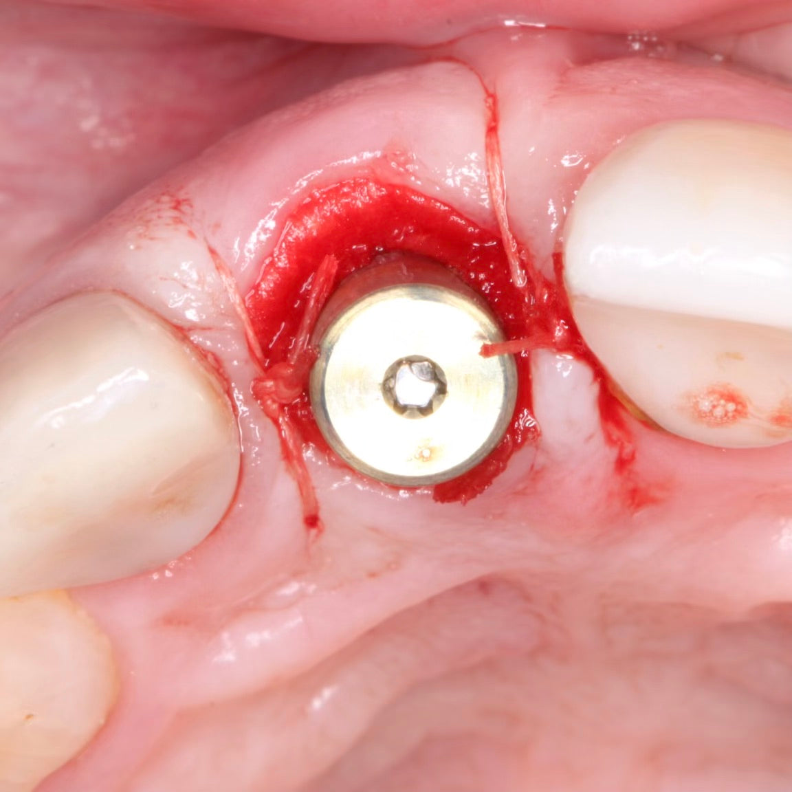 Surgery Live Streaming: Implant Placement June 14, 2024: Recording