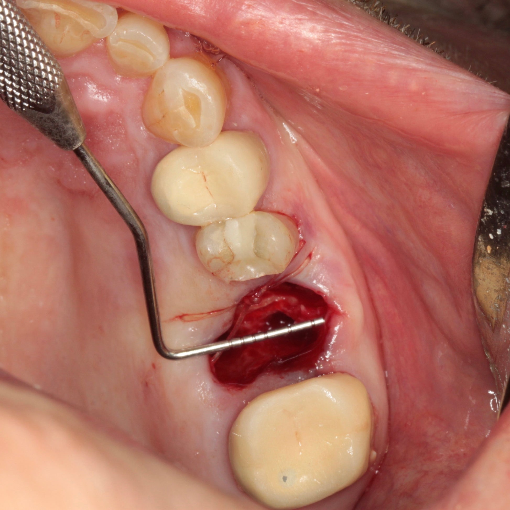  Occlusal view of upper jaw with a fresh extraction site and a periodontal probe