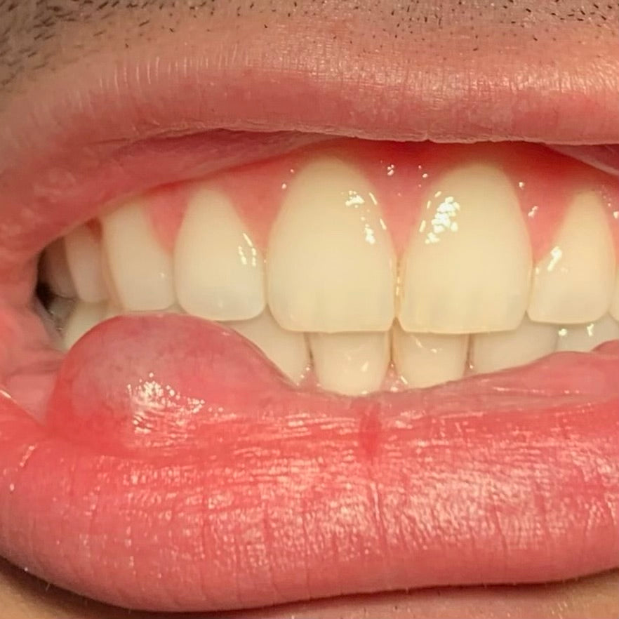 Photo of parted lips showing teeth and a swelling on the lower lip, resembling a mucocele.