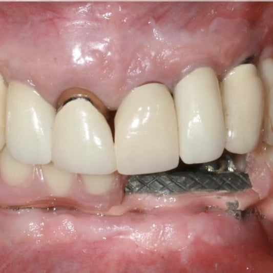Intra-oral view of heavily restored dentition with prosthesis fracture in the mandible