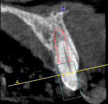 Surgery Live Streaming: Extraction and Immediate Implant Placement February 28, 2025 Recording