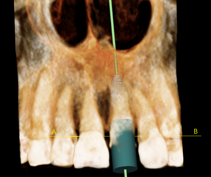 Surgery Live Streaming: Extraction and Immediate Implant Placement February 28, 2025