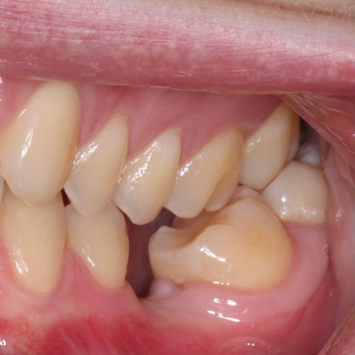 Dental Implant Replacement in Sight 35 and restorative considerations