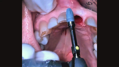 Surgery Live Streaming: Extraction and Immediate Implant Placement February 28, 2025 Recording