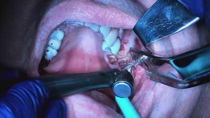 Surgery Live Streaming: Extraction and Socket Grafting September 20, 2024: Recording